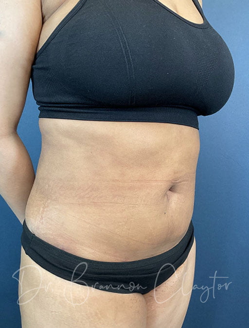smart-liposuction-abdomen-flanks-49914b-after-claytor