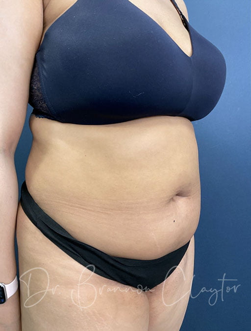 smart-liposuction-abdomen-flanks-49914b-before-claytor